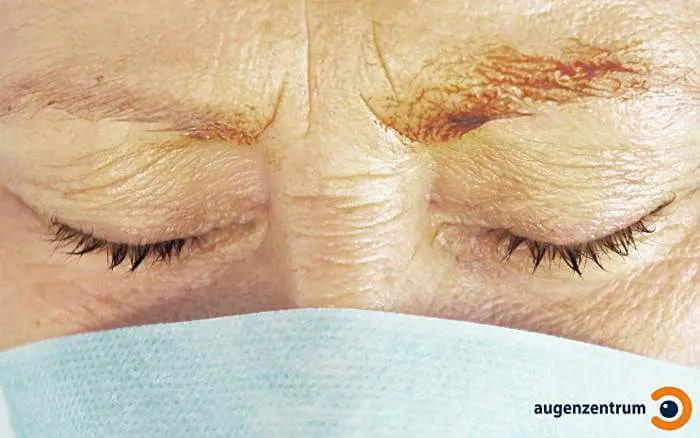 Vor der Operation: Desinfektion der Augenlider